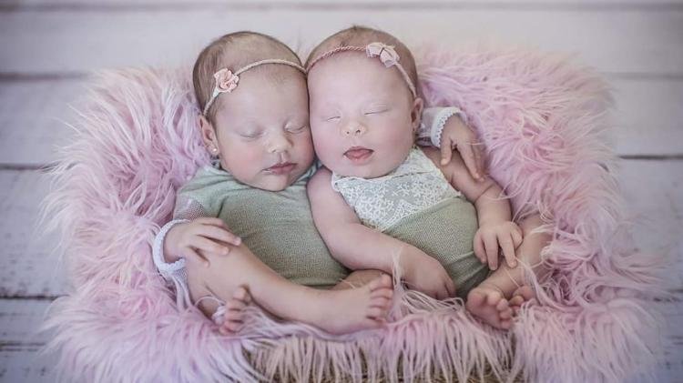 Descrição da imagem #PraCegoVer: Imagem no formato retangular, na horizontal. As irmãs gêmeas Luiza e Lívia, logo após o nascimento. Luiza tem síndrome de Down. Fim da descrição.